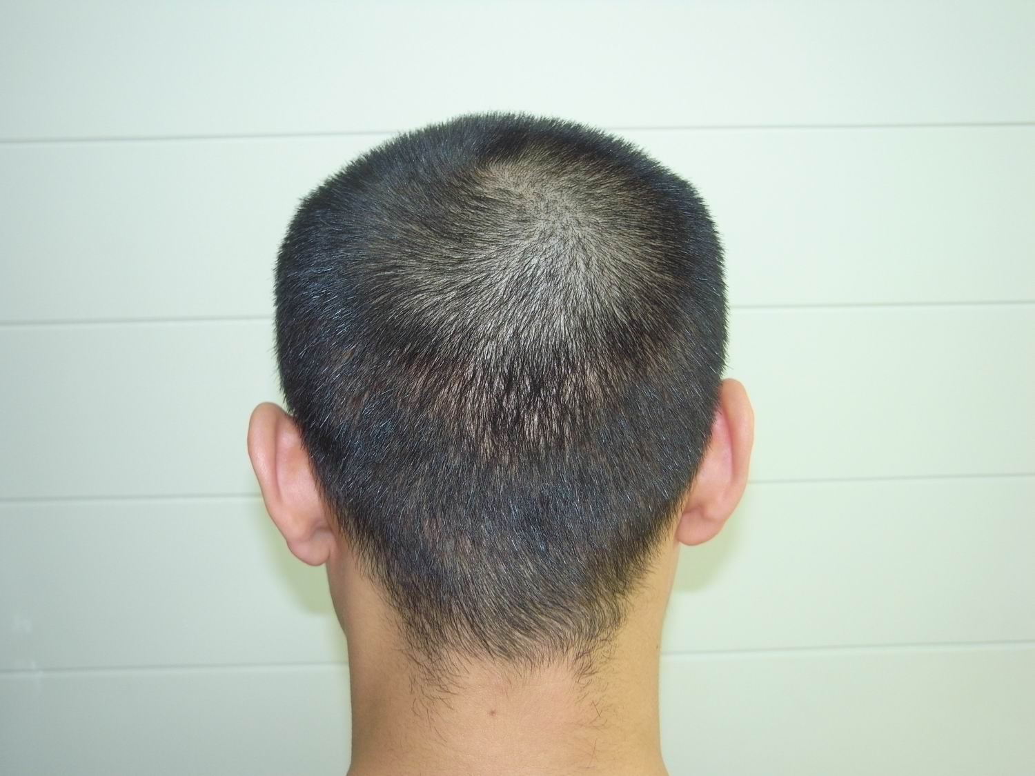 植发2~6个月效果图 - 知乎